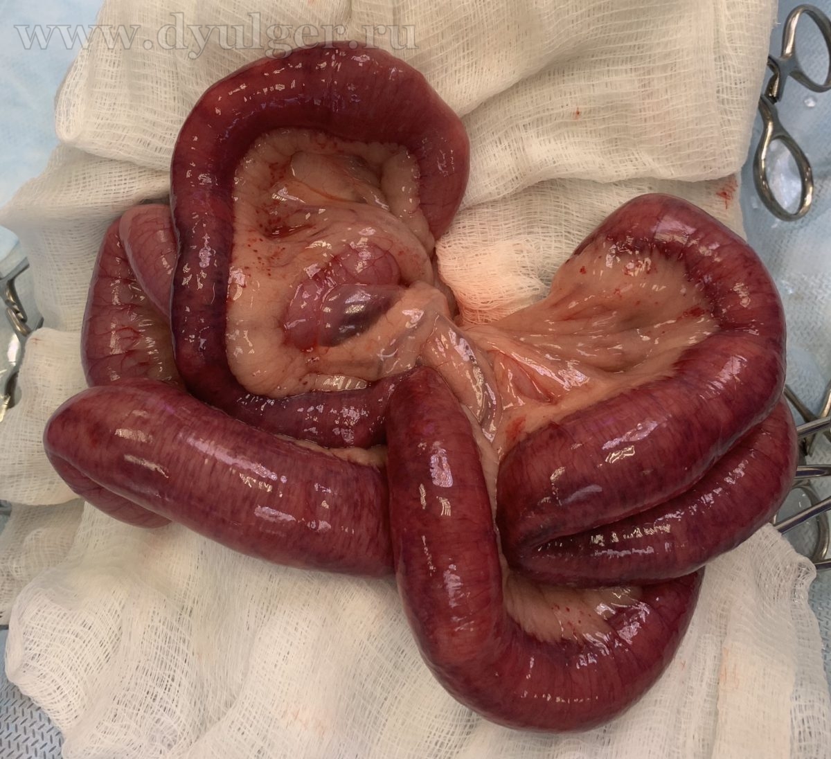 Тонкий кишечник после прохождения инородного тела
